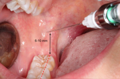 Anestesia em medicina dentária
