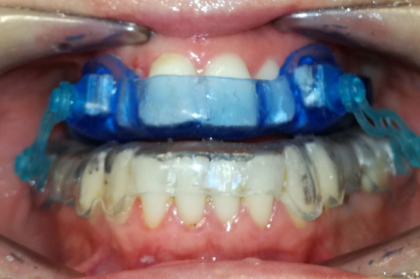 Dispositivos de avanço mandibular no tratamento da apneia obstrutiva do sono em adultos