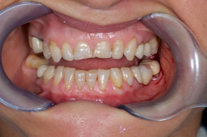 Reabilitação oral: Como elaborar um plano de tratamento em reabilitação oral (1º módulo, streaming)