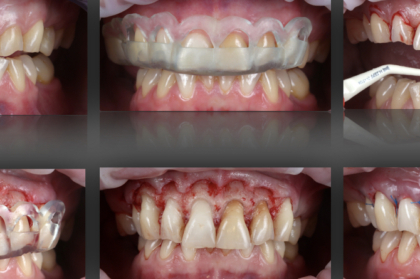 Reabilitação oral hands-on: Planeamento digital na correção do sorriso gengival (4º módulo, data 3, streaming)