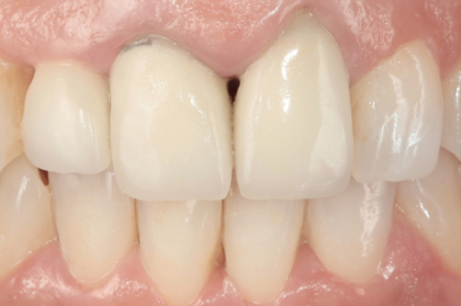 Reabilitação oral: Multidisciplinariedade e retratamento (3º módulo, streaming)