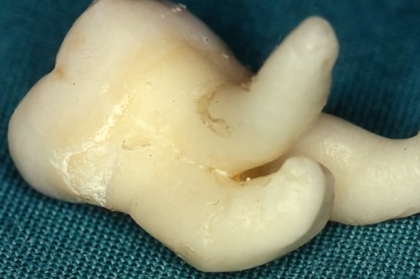 Exodontia de terceiros molares