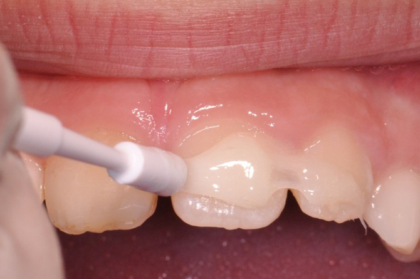 Protocolo CAMBRA (Caries Management by Risk Assessment)