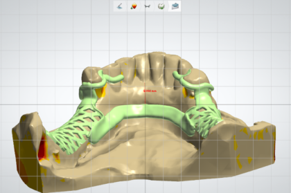 Prótese removível digital - onde estamos e para onde vamos. Estado da arte.