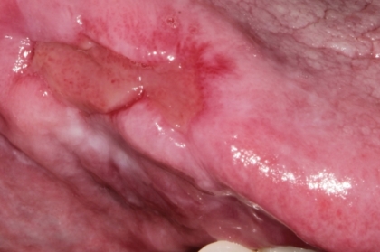 Diagnóstico diferencial de lesões ulcerativas da mucosa oral