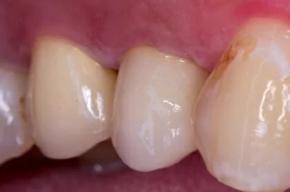O que é o sucesso em endodontia?