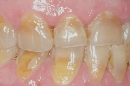 Ortodontia com alinhadores, a ortodontia do futuro?