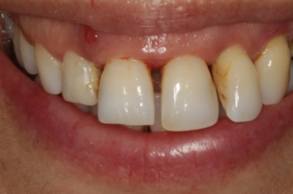 A interação bidirecional entre periodontite e doenças sistémicas