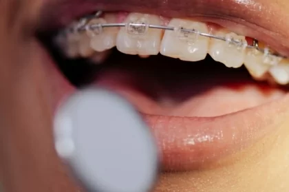 Tratamento combinado: ortodontia e prostodontia
