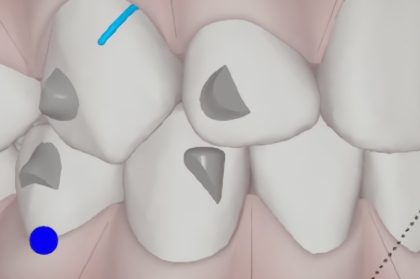 Hands-on sobre sistema Invisalign com inscrições abertas