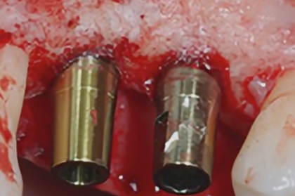 Hands-on sobre tecidos moles orientado para para próteses com inscrições abertas