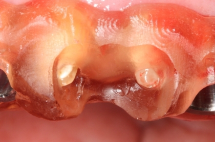 Planeamento digital na reabilitação oral com implantes