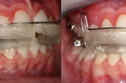 Ortodontia intercetiva na perspetiva do médico dentista generalista: quais os sinais de alerta?
