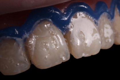Atualização em branqueamento dentário - diretivas, limitações e novos paradigmas de atuação clínica