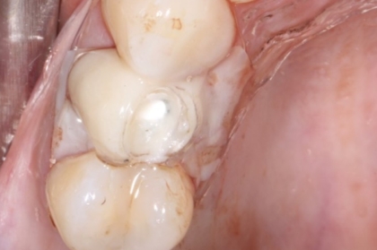 Carga imediata em implantologia