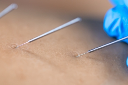 Competências setoriais: acupuntura em medicina dentária (consulta pública)