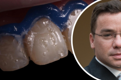 Branqueamento dentário, vídeo de curso disponível para visualização