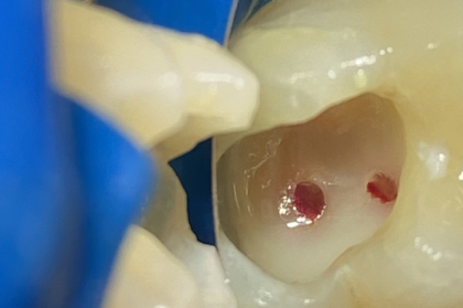 Tratamento pulpar vital: abordagem conservadora de dentes permanentes com cáries profundas