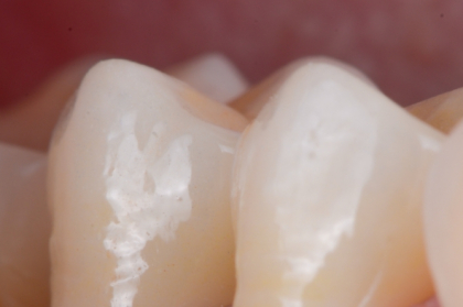 Vertiprep vs. B.O.P.T. - Uma visão clínica e técnico-laboratorial