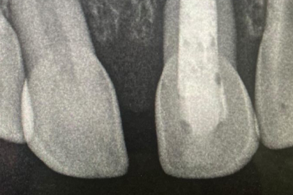 Tratamentos pulpares em dentição decídua