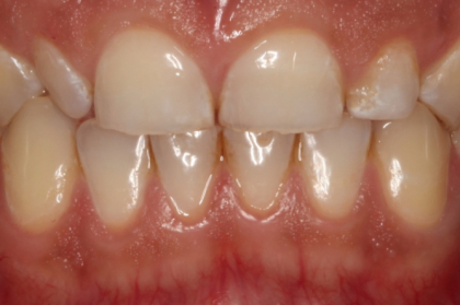 Reabilitações extensas em pacientes com bruxismo?