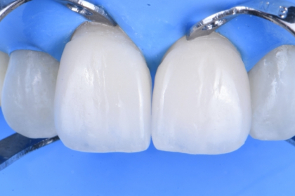 Estratégias para a reabilitação estética de dentes anteriores