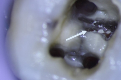 Reparação de perfurações de furca