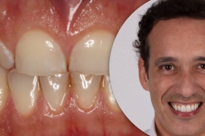 Vídeo do curso "Reabilitações extensas em pacientes com bruxismo?"