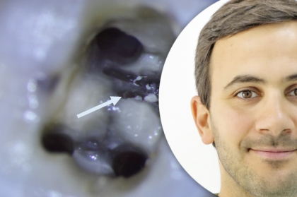 Vídeo do curso "Reparação de perfurações de furca"