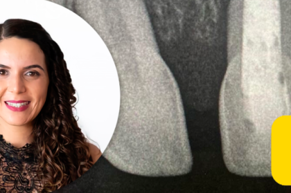 Vídeo do curso “Tratamentos pulpares em dentição decídua”