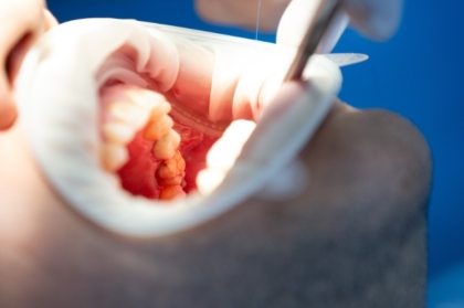 Curso modular de endodontia moderna: novas técnicas e materiais para tratamentos endodônticos