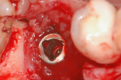 Resolução de insucessos em implantologia