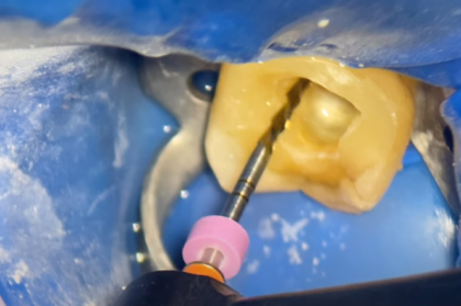 Endodontia descomplicada: mais eficiência e menos stress com dicas clínicas imediatas