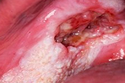 Diagnosticar Neoplasia Maligna – um desafio constante no exercício da medicina dentária