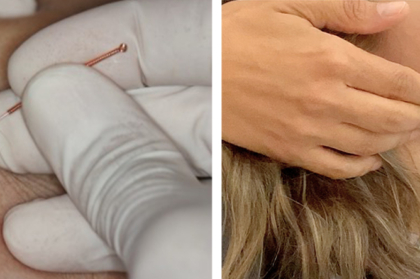 DTM mialgias e pontos miofasciais