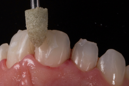 Facetas: da preparação à cimentação