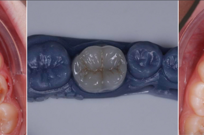 Restauração de dentes posteriores (curso presencial, DGERT)