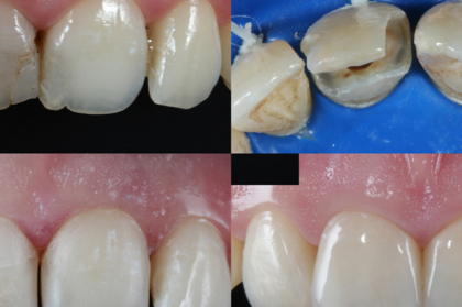 Restauração de dentes extensamente destruídos (curso presencial)