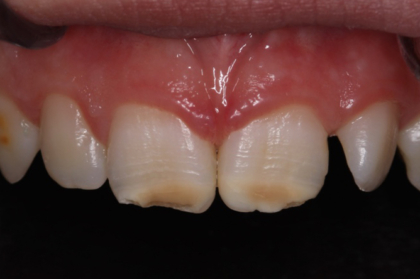 Além da mancha: o papel essencial do odontopediatra na hipomineralização molar-incisivo