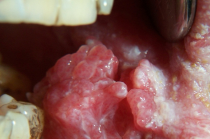 Papel do médico dentista no acompanhamento do paciente oncológico