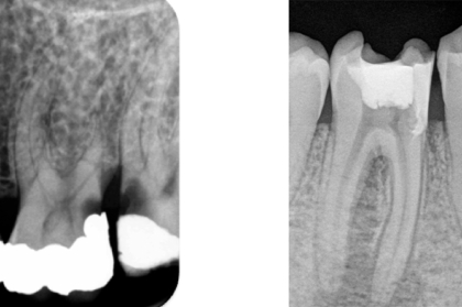 Urgências e diagnóstico em endodontia