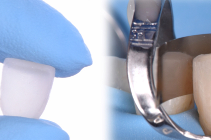 Da filosofia à prática: dentisteria adesiva minimamente invasiva com consciência clínica