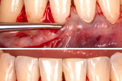 Cirurgia plástica periodontal