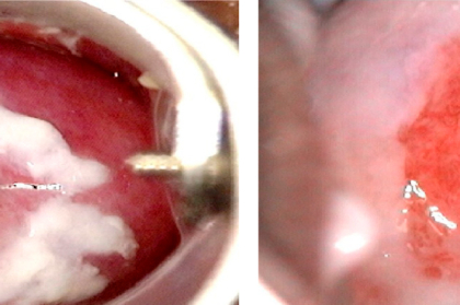 Probióticos na saúde oral e ginecológica: equilíbrio e tratamentos
