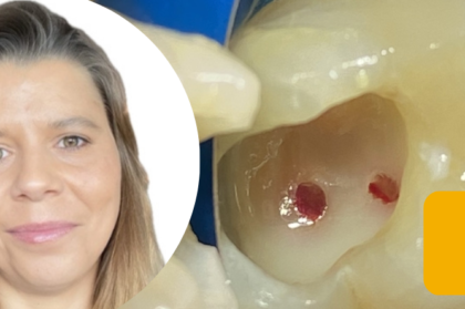 Vídeo do webinar “Tratamento pulpar vital: abordagem conservadora de dentes permanentes com cáries profundas”