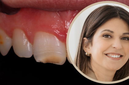 Webinar de hipomineralização molar-incisivo: inscrições abertas