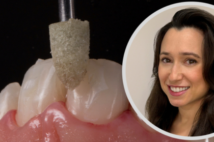 Inscrições abertas: webinar clínico sobre facetas