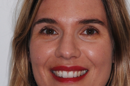 Tratamento ortodôntico precoce - classe III