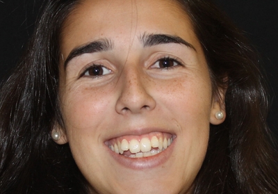 Diagnóstico diferencial de lesões orais associadas ao HPV - série de casos