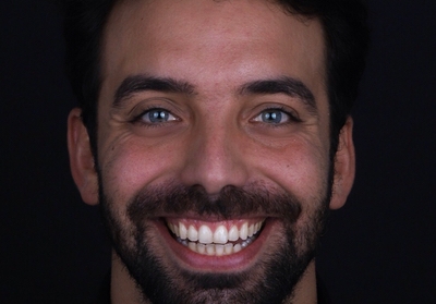 Tratamento de sorriso gengival - série de casos clínicos